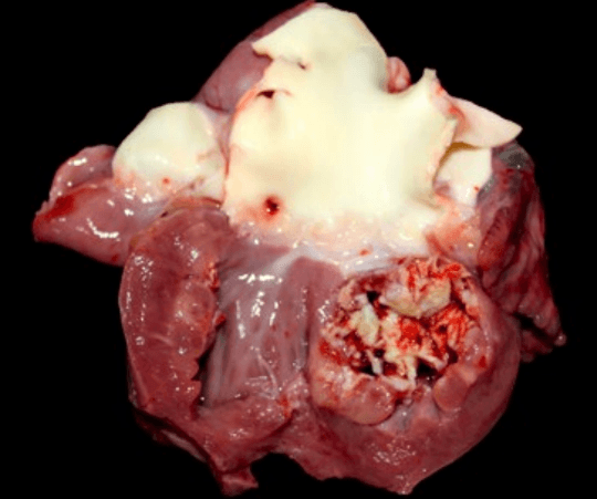 endocarditis