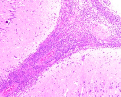 meningitis fibrinosupurativa